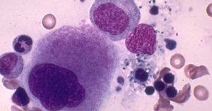 Болезнь Гоше: 9 вопросов по теме